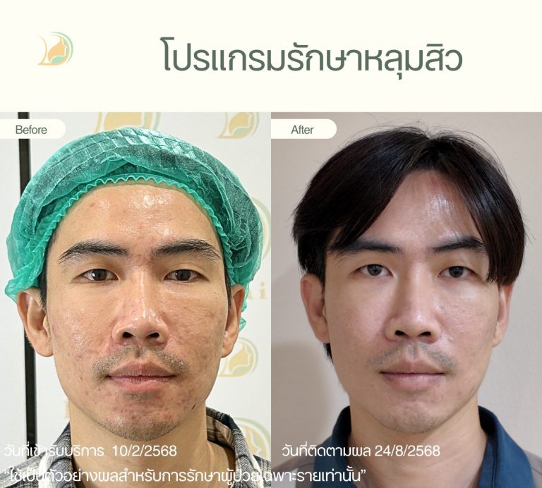 รีวิวผลลัพธ์รักษาหลุมสิวผู้ชาย อ้อมใหญ่ ดูแลโดยคุณหมอนัท คลินิกอ้อมใหญ่รวมแพทย์