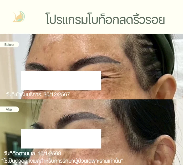 ผลลัพธ์ โปรแกรมโบทูลินั่ม ท็อกซิน ลดรอยตีนกา คืนความอ่อนเยาว์ คลินิกอ้อมใหญ่รวมแพทย์