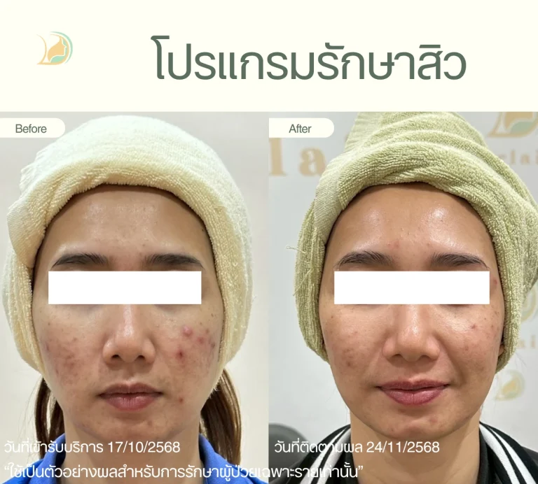 รีวิวก่อน-หลัง รักษาสิวอุดตันและสิวอักเสบ คลินิกอ้อมใหญ่รวมแพทย์