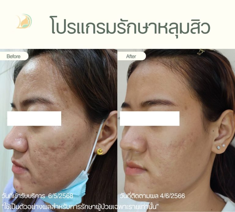 ผลการฟื้นฟูหลุมสิวลึกด้วยเทคนิคผสมผสาน คลินิกอ้อมใหญ่รวมแพทย์ ดูแลโดยหมอผิวหนัง