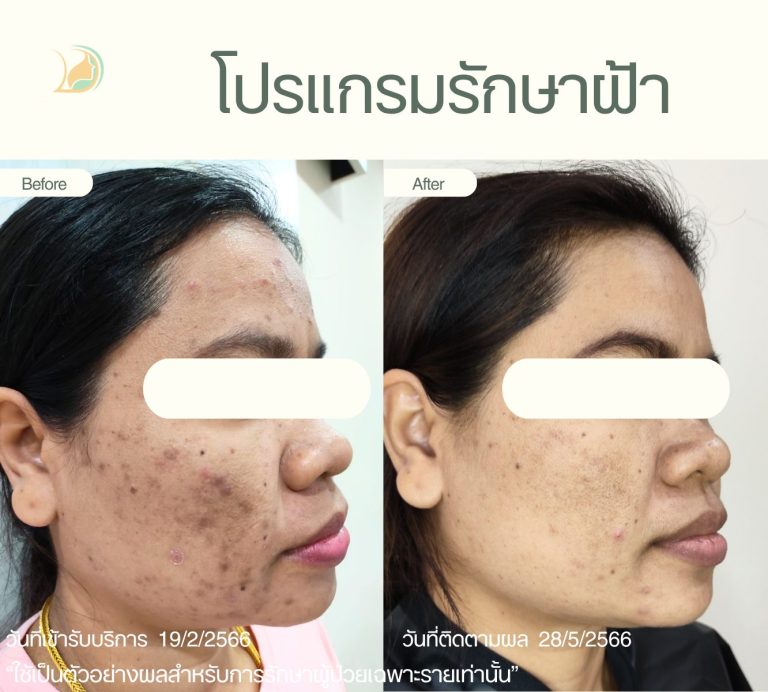 รีวิวเลเซอร์รักษาจุดด่างดำและกระลึก อ้อมใหญ่ ดูแลอย่างใกล้ชิดโดยแพทย์เฉพาะทาง