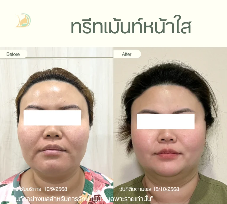 รีวิวผลลัพธ์ ทรีทเม้นท์หน้าใส อ้อมใหญ่ บำรุงผิวล้ำลึก ผิวอิ่มฟูกระจ่างใส คลินิกอ้อมใหญ่รวมแพทย์