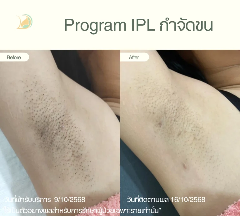 รีวิวผลลัพธ์เลเซอร์ขนรักแร้ อ้อมใหญ่ ผิวกระจ่างใสขึ้น ลดการระคายเคือง