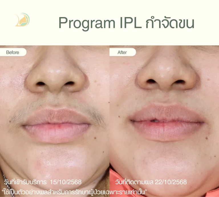 รีวิวกำจัดขนหนวด อ้อมใหญ่ ด้วยเทคโนโลยี IPL ผิวเรียบเนียน คลินิกอ้อมใหญ่รวมแพทย์