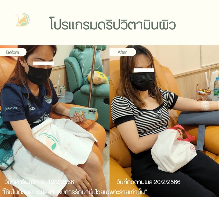 บรรยากาศการรับบริการดริปวิตามินผิว IV Drip อ้อมใหญ่ คลินิกอ้อมใหญ่รวมแพทย์ แผนกผิวหนัง