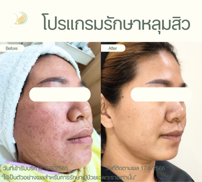 รีวิวเลเซอร์รักษาหลุมสิวและรอยแดง อ้อมใหญ่ ประเมินการรักษาโดยแพทย์เฉพาะทาง