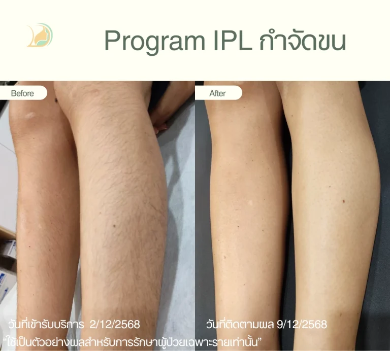 ผลการกำจัดขนขา เผยผิวเนียนใส คลินิกอ้อมใหญ่รวมแพทย์ แผนกผิวหนัง