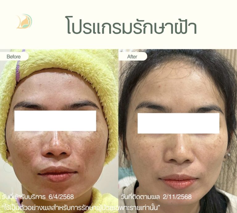 รีวิวรักษาฝ้า กระ จุดด่างดำ อ้อมใหญ่ ประเมินและดูแลโดยคุณหมอนัท คลินิกอ้อมใหญ่รวมแพทย์