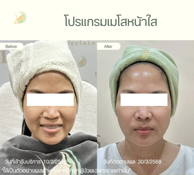 ภาพก่อนและหลังทำ โปรแกรมเมโสหน้าใส ฟื้นฟูผิวหมองคล้ำให้ดูกระจ่างใสขึ้น ดูแลโดยแพทย์