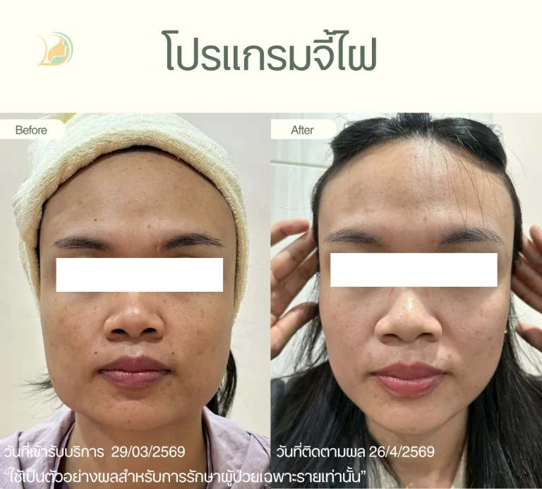 รีวิวผลลัพธ์จี้ไฝด้วยเลเซอร์ อ้อมใหญ่ แผลเล็ก ฟื้นตัวไว คลินิกอ้อมใหญ่รวมแพทย์ แผนกผิวหนัง
