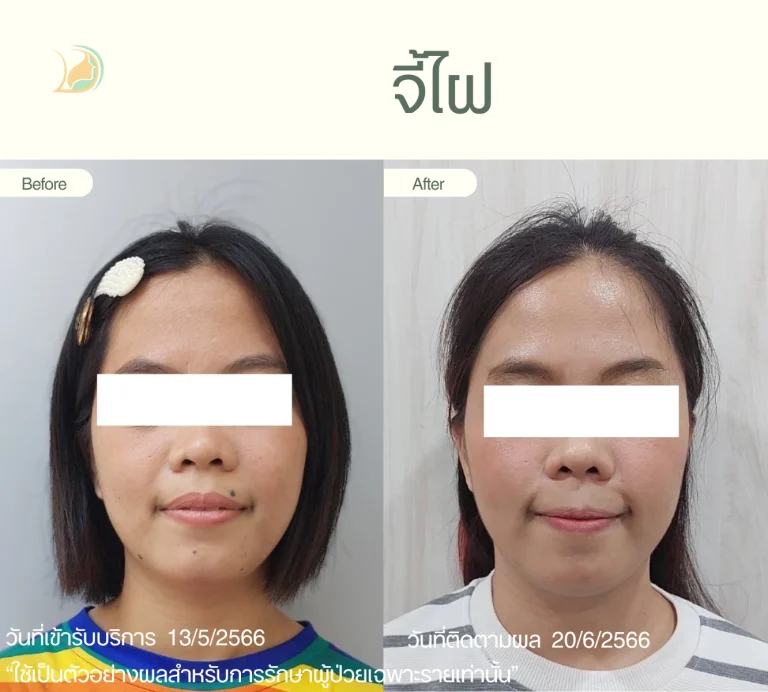 รีวิวผลลัพธ์จี้ไฝ ขี้แมลงวัน ติ่งเนื้อ บริเวณใบหน้า แผลเล็ก ดูแลโดยคุณหมอนัท คลินิกอ้อมใหญ่รวมแพทย์