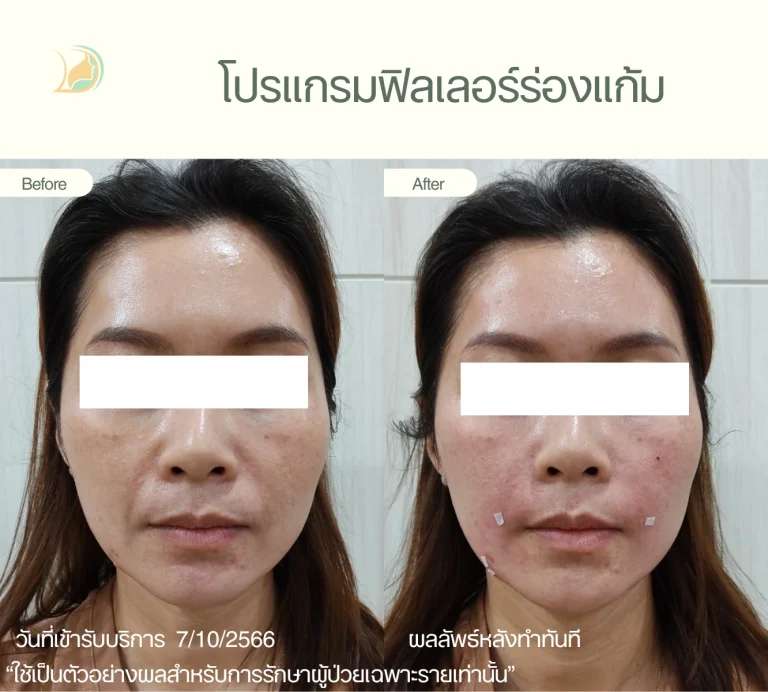 ผลลัพธ์ โปรแกรมฟิลเลอร์ เติมเต็มร่องแก้ม คืนความอ่อนเยาว์ คลินิกอ้อมใหญ่รวมแพทย์ แผนกผิวหนัง