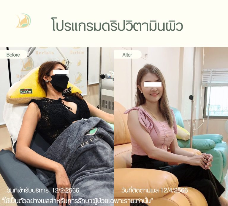 รีวิวดริปวิตามินสูตรพรีเมียม Bright and Boost ดูแลโดยคุณหมอนัท คลินิกอ้อมใหญ่รวมแพทย์