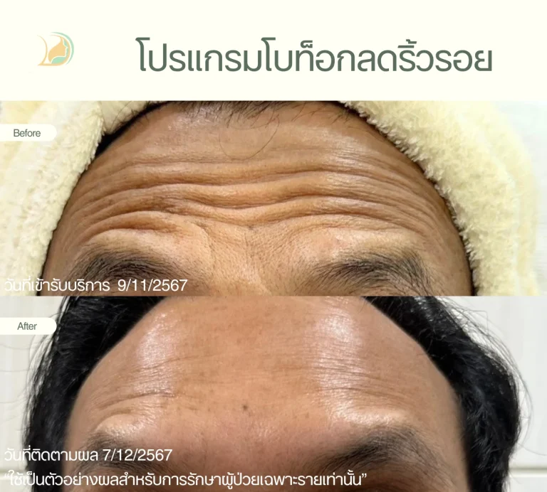 รีวิวผลลัพธ์ โปรแกรมโบท็อก ลดรอยย่นหน้าผาก อ้อมใหญ่ คลินิกอ้อมใหญ่รวมแพทย์