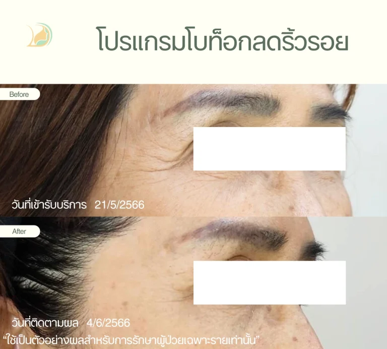 ภาพก่อนและหลังฉีด โปรแกรมโบท็อก ลดริ้วรอยหางตา อ้อมใหญ่ ดูแลโดยคุณหมอนัท