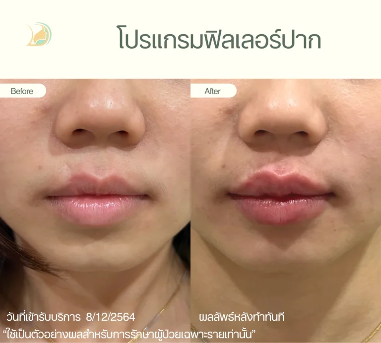 รีวิวผลลัพธ์ โปรแกรมฟิลเลอร์ ปาก อ้อมใหญ่ คลินิกอ้อมใหญ่รวมแพทย์