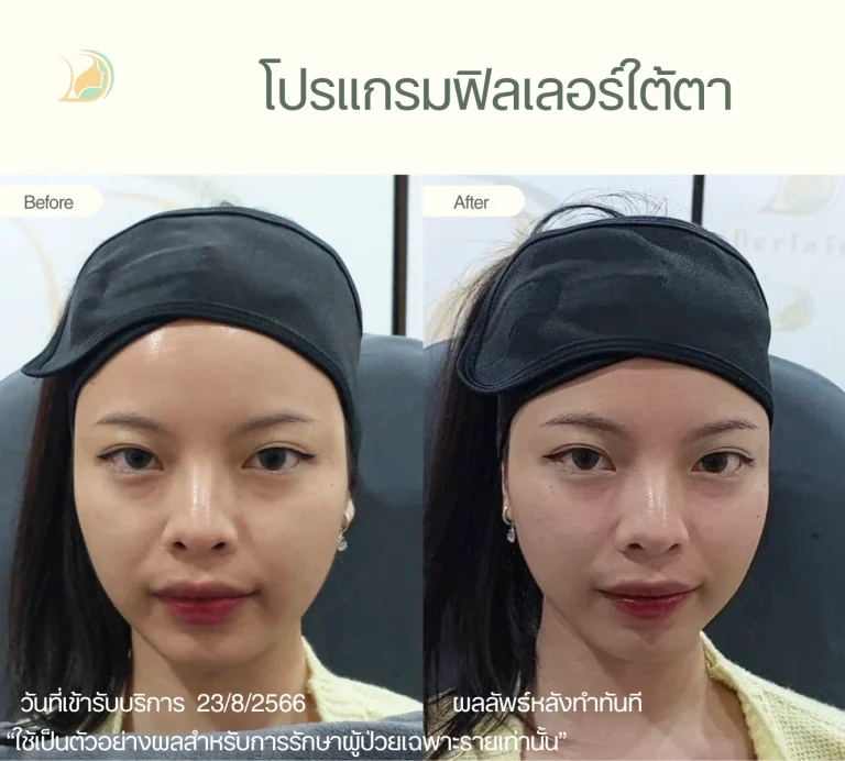 ภาพก่อนและหลังฉีด โปรแกรมฟิลเลอร์ ใต้ตา อ้อมใหญ่ เติมเต็มร่องลึกอย่างเป็นธรรมชาติ