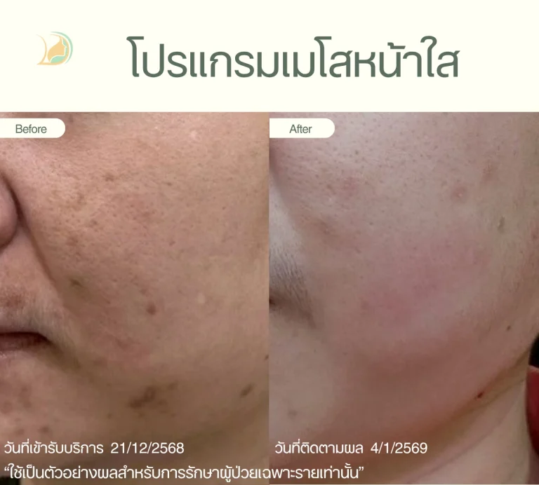 รีวิวผลลัพธ์ โปรแกรมเมโสหน้าใส ลดรอยดำจากสิว อ้อมใหญ่ คลินิกอ้อมใหญ่รวมแพทย์