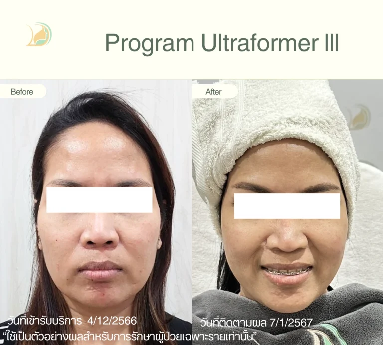 รีวิวผลลัพธ์ Program Ultraformer III ยกกระชับใบหน้า อ้อมใหญ่ คลินิกอ้อมใหญ่รวมแพทย์
