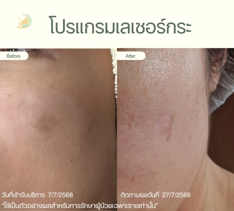 รีวิวโปรแกรมเลเซอร์กระ Q-Switch ลดเม็ดสีสะสม อ้อมใหญ่ คลินิกอ้อมใหญ่รวมแพทย์