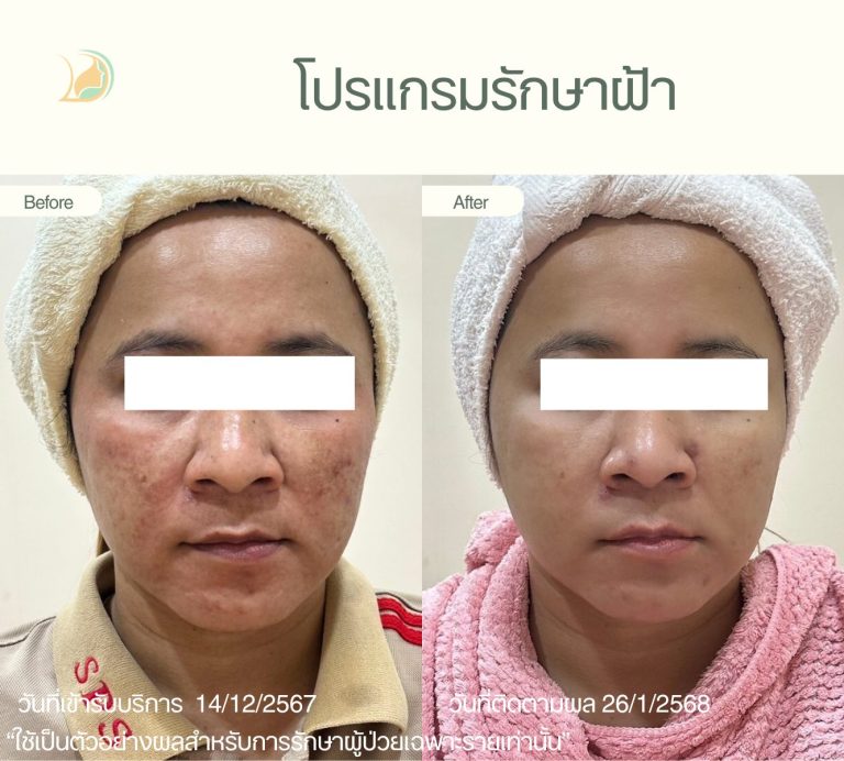 ภาพก่อนและหลังโปรแกรมดูแลฝ้าแดด ฝ้าฮอร์โมน คลินิกอ้อมใหญ่รวมแพทย์ แผนกผิวหนัง