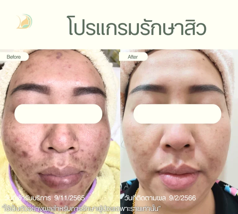 รีวิวรักษาสิวเรื้อรังและรอยดำ คลินิกอ้อมใหญ่รวมแพทย์