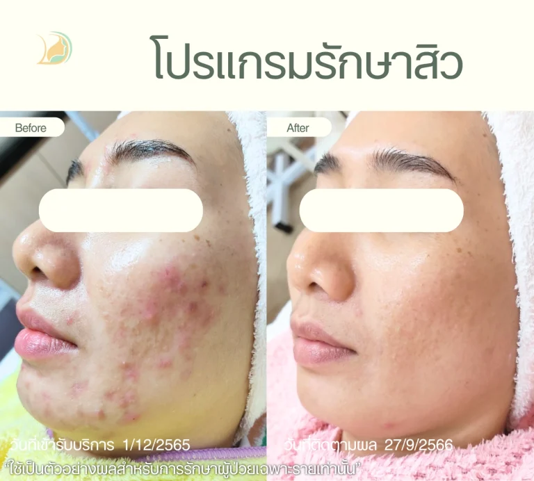 รีวิวผลลัพธ์รักษาสิวด้วยเลเซอร์ ลดรอยแดง คลินิกอ้อมใหญ่รวมแพทย์