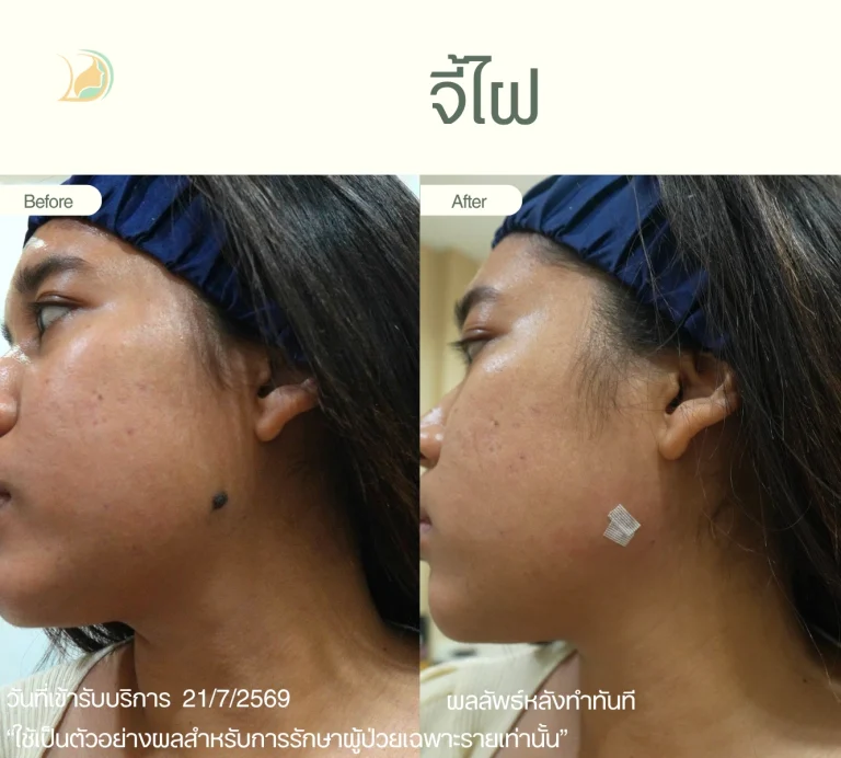 รีวิวจี้ไฝนูนขนาดใหญ่บริเวณแก้ม อ้อมใหญ่ แผลขนาดเล็ก ดูแลโดยแพทย์ คลินิกอ้อมใหญ่รวมแพทย์ แผนกผิวหนัง