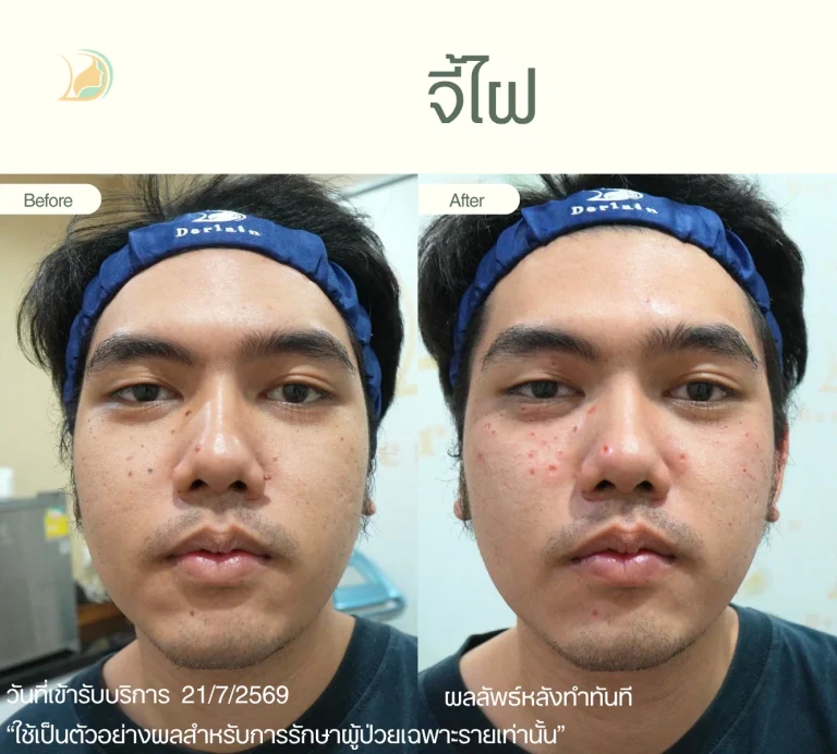 รีวิวจี้ไฝและขี้แมลงวันหลายจุดทั่วใบหน้าผู้ชาย ด้วยเลเซอร์ อ้อมใหญ่ คลินิกอ้อมใหญ่รวมแพทย์ แผนกผิวหนัง
