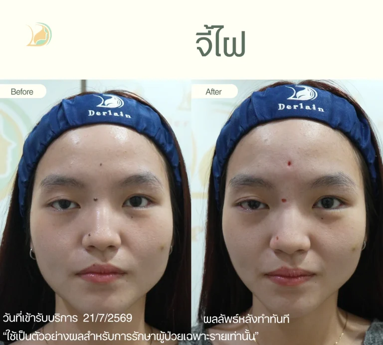 รีวิวจี้ไฝบริเวณหน้าผาก ดั้งจมูก และหางตา อ้อมใหญ่ ผลลัพธ์หลังทำทันที คลินิกอ้อมใหญ่รวมแพทย์ แผนกผิวหนัง