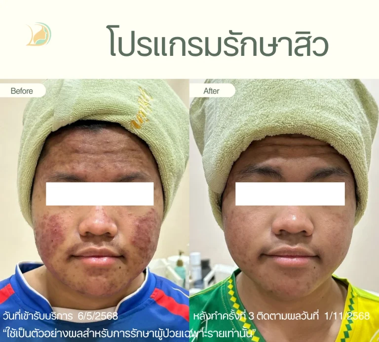 รีวิวรักษาสิวอักเสบและรอยสิวทั่วหน้า โดยคุณหมอนัท คลินิกอ้อมใหญ่รวมแพทย์