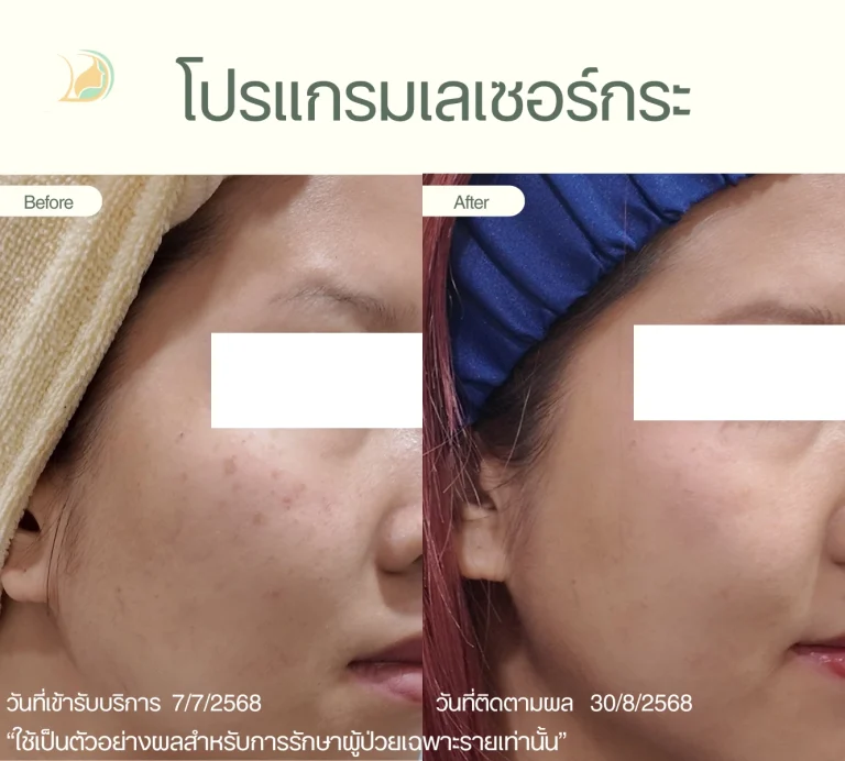 รีวิวโปรแกรมเลเซอร์หน้าใส ลดจุดด่างดำ ดูแลโดยคุณหมอนัท คลินิกอ้อมใหญ่รวมแพทย์