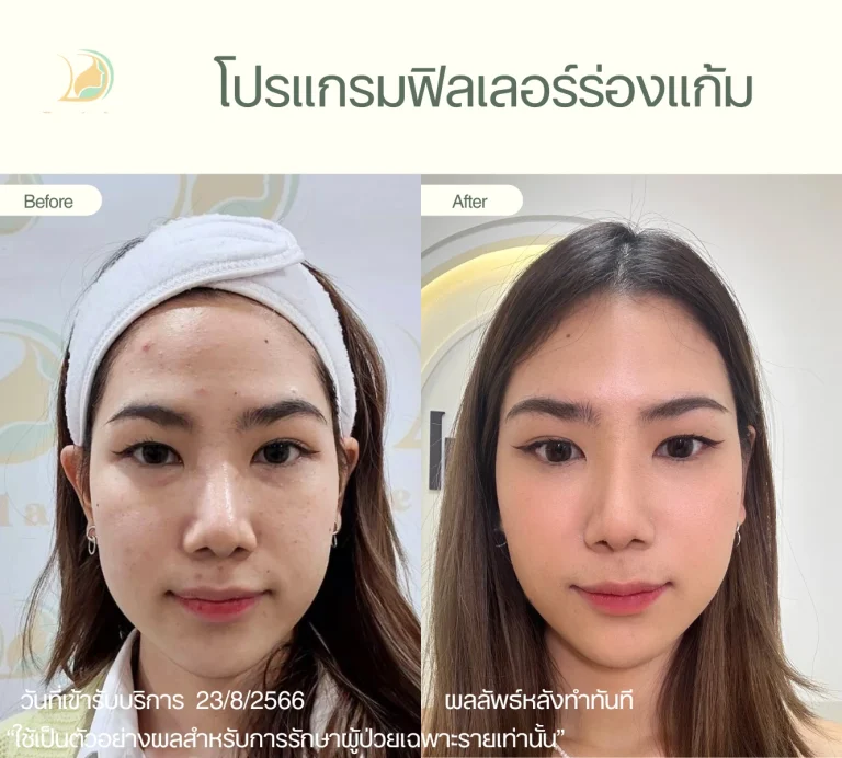 รีวิว โปรแกรมฟิลเลอร์ ร่องแก้ม ปรับรูปหน้า ดูแลโดยแพทย์เฉพาะทาง