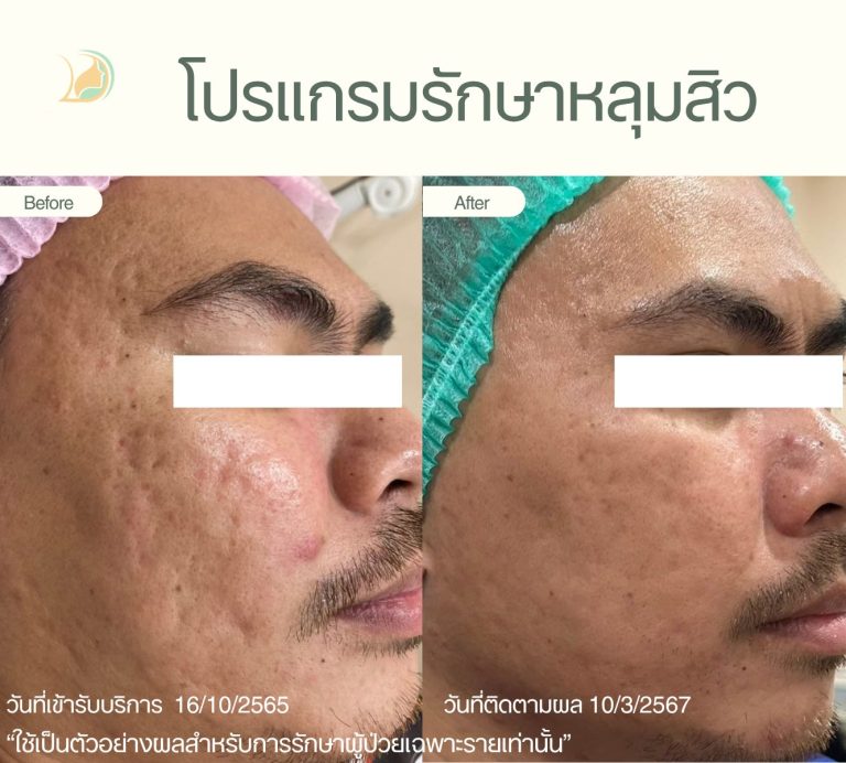 ภาพก่อนและหลังทำ Subcision ตัดพังผืดและเลเซอร์หลุมสิว คลินิกอ้อมใหญ่รวมแพทย์ แผนกผิวหนัง