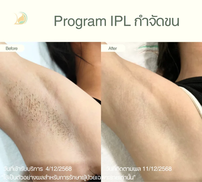 ภาพก่อนและหลังกำจัดขนรักแร้ ลดปัญหาขนคุด ดูแลโดยคุณหมอนัท