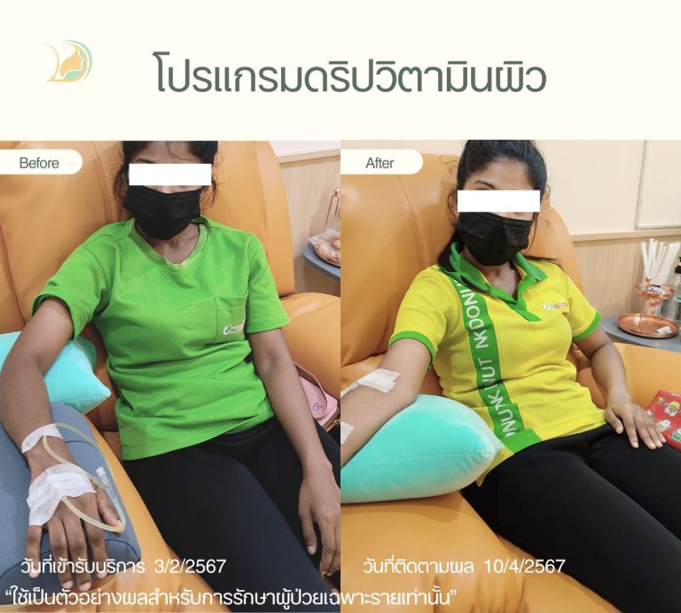 รีวิวดริปวิตามินผิวสูตรล้างสารพิษ ปรับสีผิวให้ดูสม่ำเสมอ อ้อมใหญ่ คลินิกอ้อมใหญ่รวมแพทย์