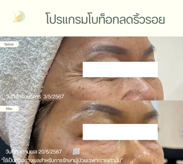 รีวิว โปรแกรมโบท็อก จัดการริ้วรอยรอบดวงตาอย่างเป็นธรรมชาติ ประเมินโดยแพทย์เฉพาะทาง